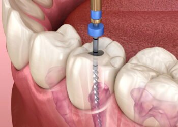 Dr. Cláudio Pinho, Dentista: o que acontece após um Canal mal feito?