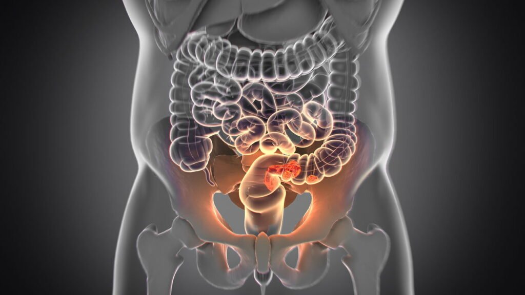Esse é o terceiro câncer mais mortal e o número de diagnósticos estão aumentando cada vez mais