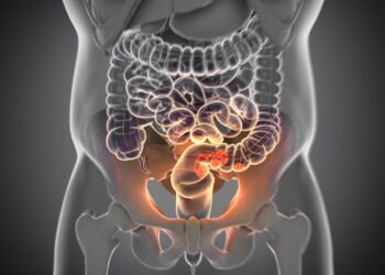 Esse é o terceiro câncer mais mortal e o número de diagnósticos estão aumentando cada vez mais