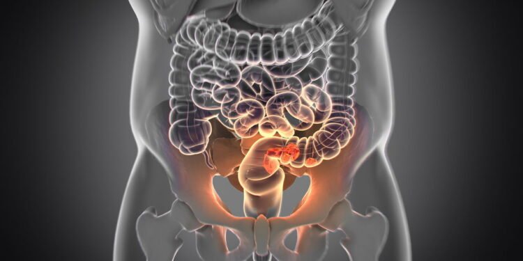 Esse é o terceiro câncer mais mortal e o número de diagnósticos estão aumentando cada vez mais