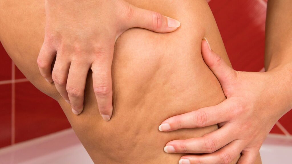 O tratamento anticelulite mais potente do momento está ganhando o Brasil