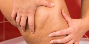 O tratamento anticelulite mais potente do momento está ganhando o Brasil