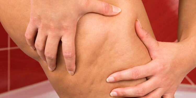 O tratamento anticelulite mais potente do momento está ganhando o Brasil