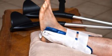 Entorse de tornozelo melhora mais rápido com fisioterapia iniciada no mesmo dia