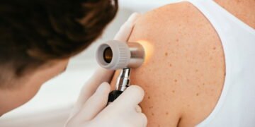 Dr. Patrizio Morisson, Cirurgião: o sinal na pele que pode indicar o câncer mais perigoso