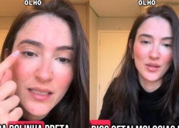 Oftalmologista Gabi: “Você nunca viu ninguém ensinando como coçar o olho”