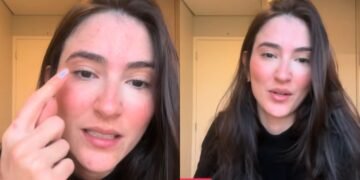 Oftalmologista Gabi: “Você nunca viu ninguém ensinando como coçar o olho”