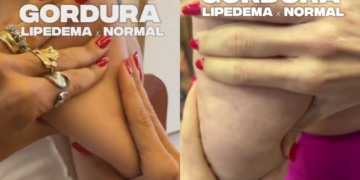 Dra. Nathalia Dal-Prá ensina a como identificar lipedema sem confundir com gordura comum