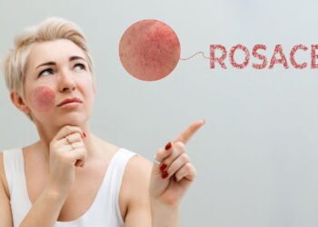 O melhor guia para entender e controlar a rosácea na pele