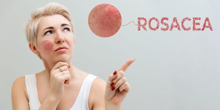 O melhor guia para entender e controlar a rosácea na pele
