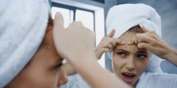 Acne hormonal em adultos é mais comum do que você imagina