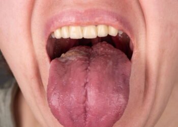 Ferida na boca que não cicatriza o alerta que você ignora