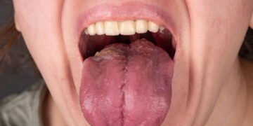 Ferida na boca que não cicatriza o alerta que você ignora