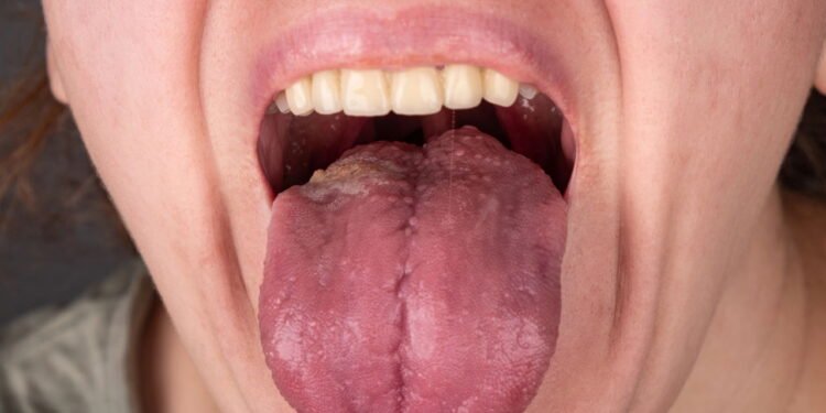 Câncer Bucal - Créditos: depositphotos.com / fukume