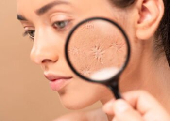 O tratamento mais eficaz para cicatrizes de acne revelado