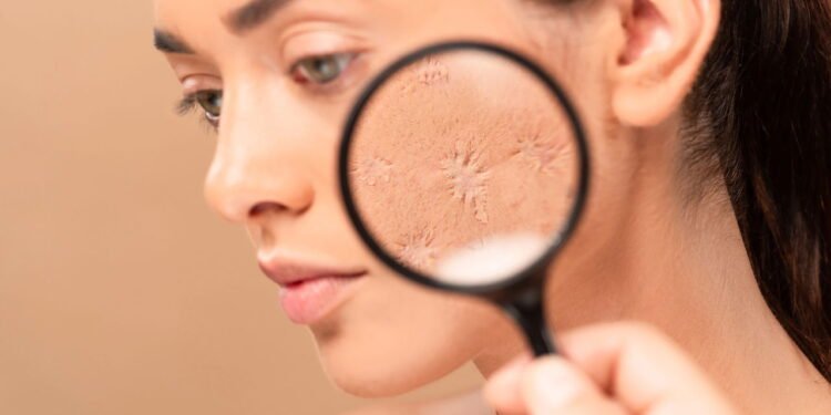 Cicatrizes de Acne - Créditos: depositphotos.com / IgorVetushko