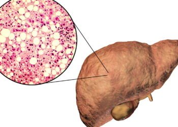 Como prevenir e tratar a gordura no fígado