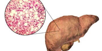 Como prevenir e tratar a gordura no fígado
