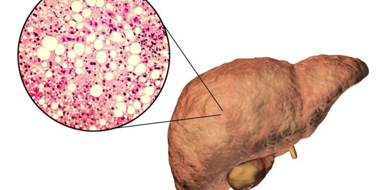 Esteatose Hepática - Créditos: depositphotos.com / katerynakon