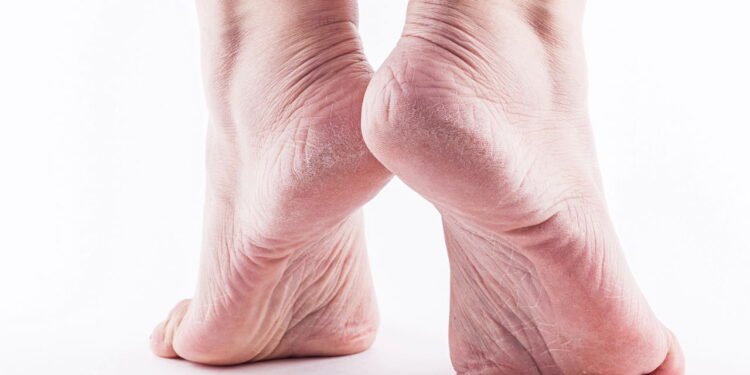 Método caseiro que transformou a rotina de quem sofre com pés secos