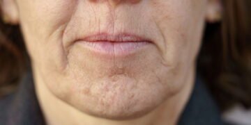 Máscaras caseiras que suavizam linhas de expressão de forma simples