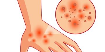 Coceira na mão esquerda pode ser um sintoma preocupante