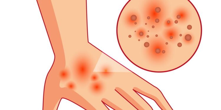 Coceira na mão - Créditos: depositphotos.com / slobodyan_78