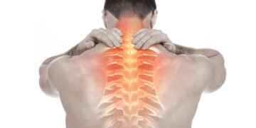 Como aliviar dores causadas por escoliose sem cirurgia usando fisioterapia