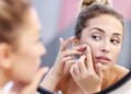 Como manter o rosto sem manchas após muitas espinhas