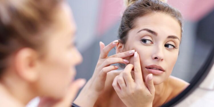 Como manter o rosto sem manchas após muitas espinhas