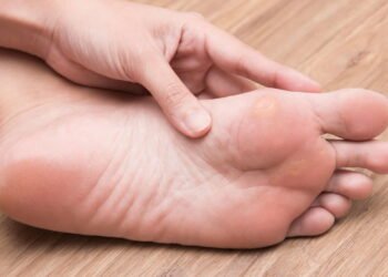 Como remover fungos e calosidades dos pés usando um tempero de cozinha