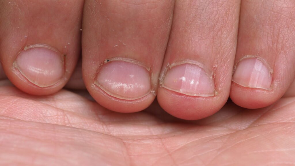 O que significam as manchas brancas na unha