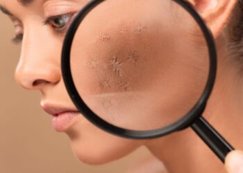 Os melhores remédios caseiros que clareiam manchas no rosto de forma natural