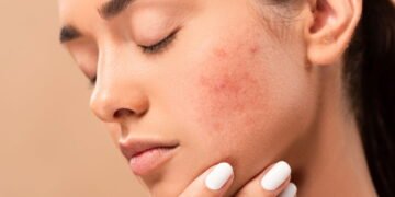 Os melhores remédios caseiros que clareiam manchas no rosto de forma natural