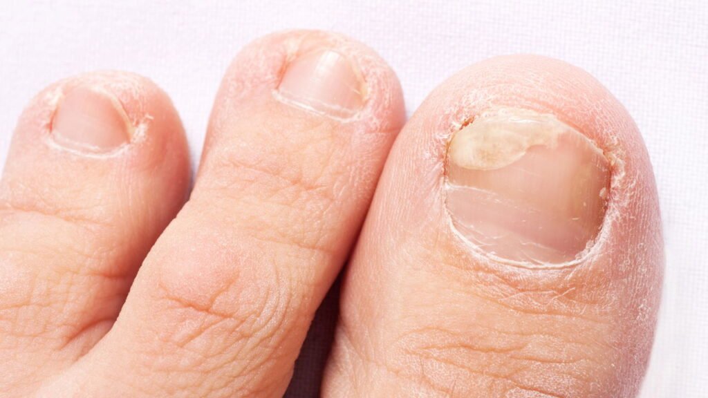 Os melhores cuidados para evitar fungos e manter unhas perfeitas