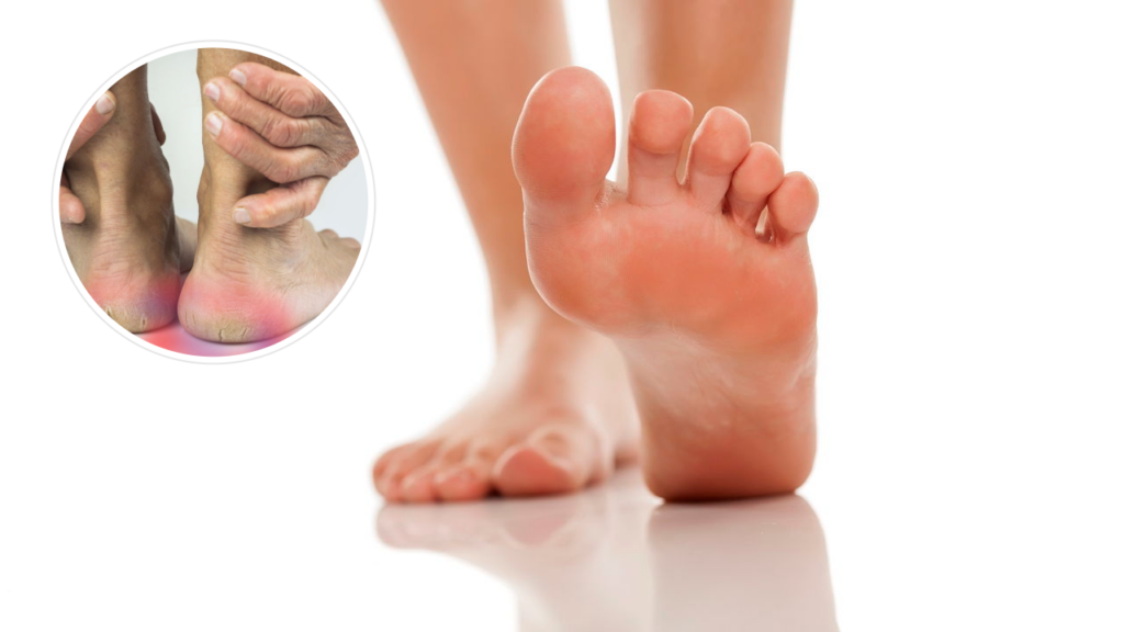 Como tratar rachaduras nos pés com essa receita simples