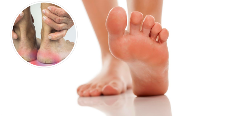 Como tratar rachaduras nos pés com essa receita simples