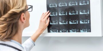 A vitamina essencial para manter seus ossos fortes