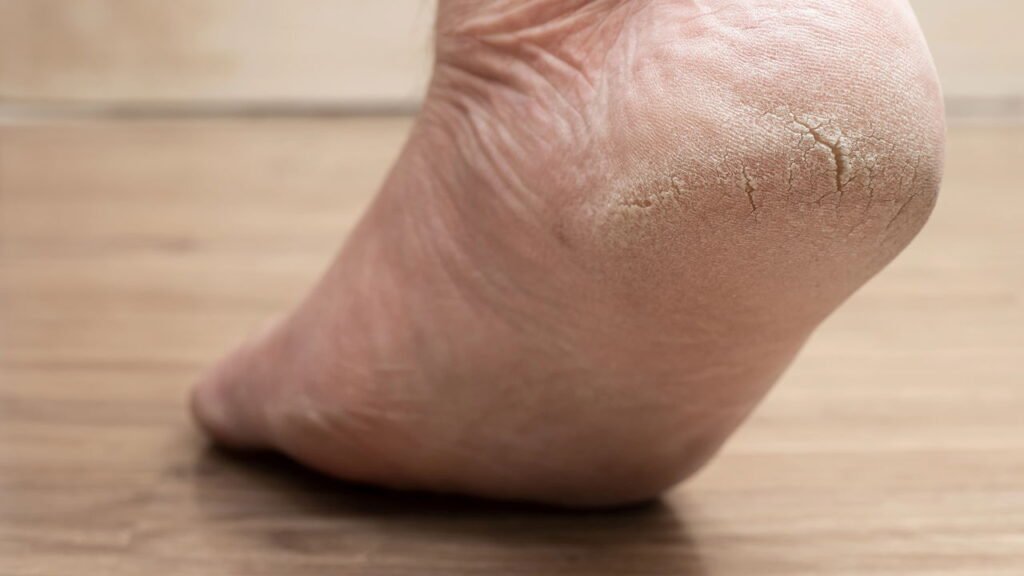 Como tratar rachaduras nos pés com essa receita simples