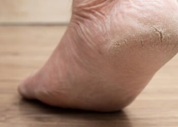 Como tratar rachaduras nos pés com essa receita simples