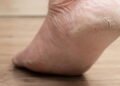 Como hidratar pés secos e rachados usando ingredientes naturais