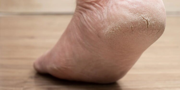 Como hidratar pés secos e rachados usando ingredientes naturais
