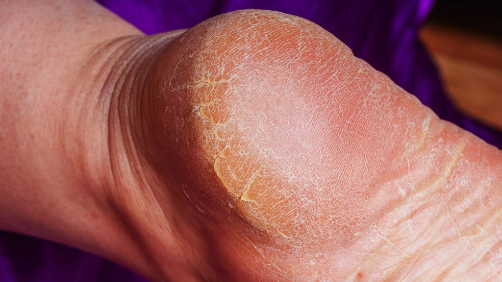 Como hidratar pés secos e rachados usando ingredientes naturais