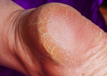 Como hidratar pés secos e rachados usando ingredientes naturais