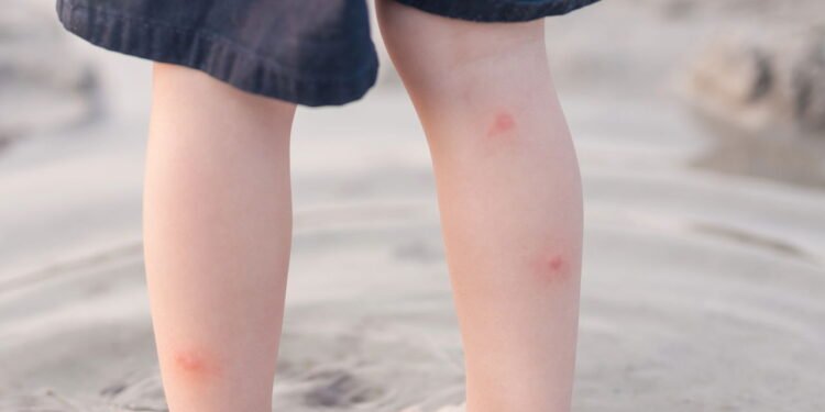 Métodos naturais aliviam a coceira - Créditos: depositphotos.com / zoeytoja