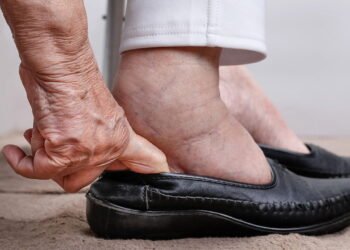 Os chás diuréticos que ajudam a reduzir retenção de líquidos