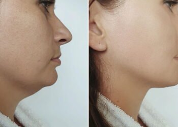 Os alimentos perfeitos para ajudar a desinchar o rosto