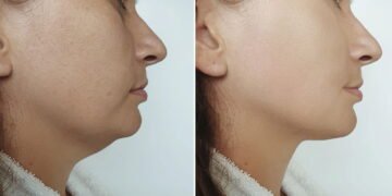 Os alimentos perfeitos para ajudar a desinchar o rosto