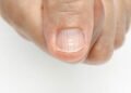 O que significam manchas brancas nas unhas e como tratar