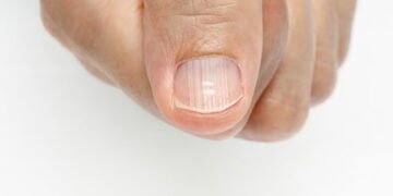 O que significam manchas brancas nas unhas e como tratar